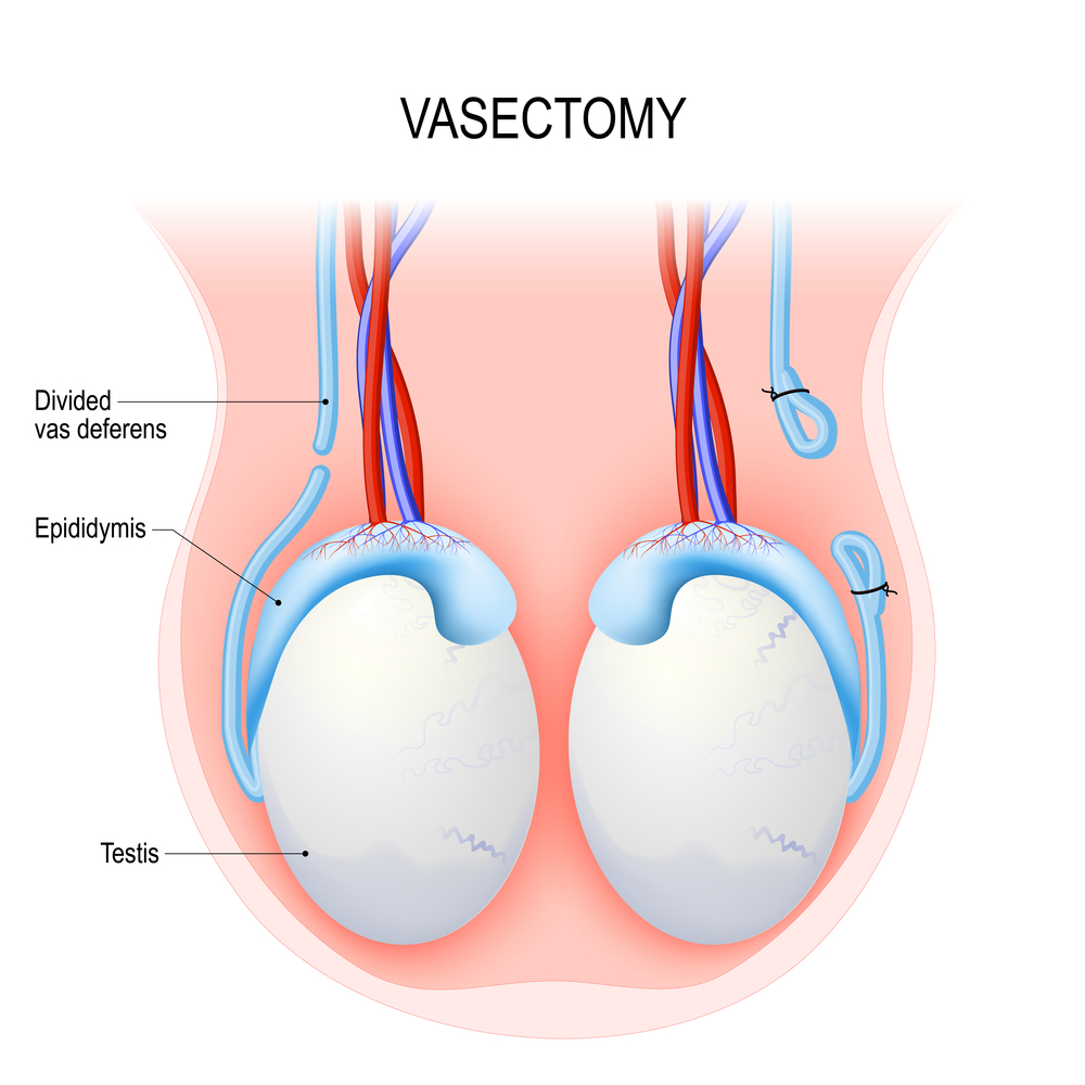 After vasectomy sperm retrieval