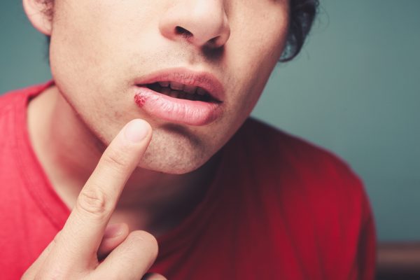 Do Cold Sores Mean You Have An STD? - Male UltraCore Blog